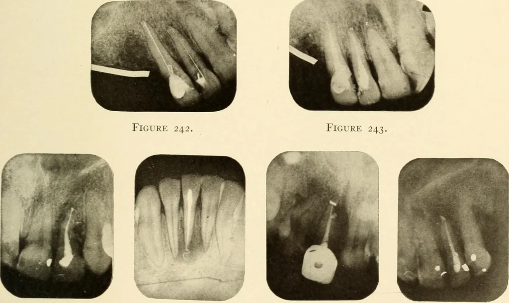 An illustration from Oral Roentgenology : a Roentgen study of the anatomy and pathology of the oral cavity, 1917, leaf 178
