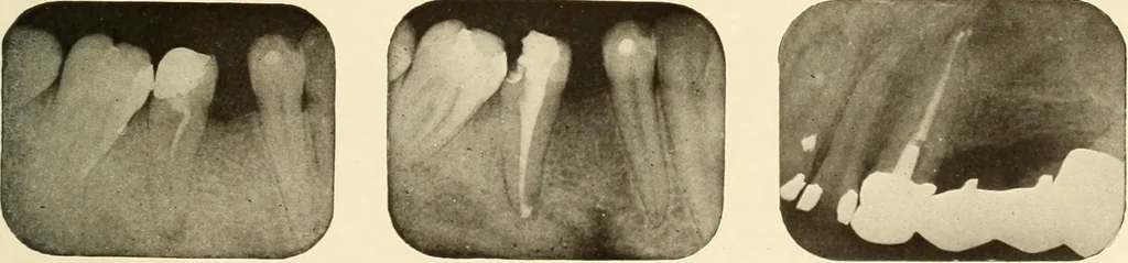 An illustration from Oral Roentgenology : a Roentgen study of the anatomy and pathology of the oral cavity, 1917, leaf 178