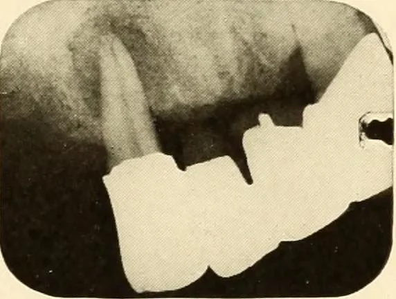 An illustration from Oral Roentgenology : a Roentgen study of the anatomy and pathology of the oral cavity, 1917, leaf 180