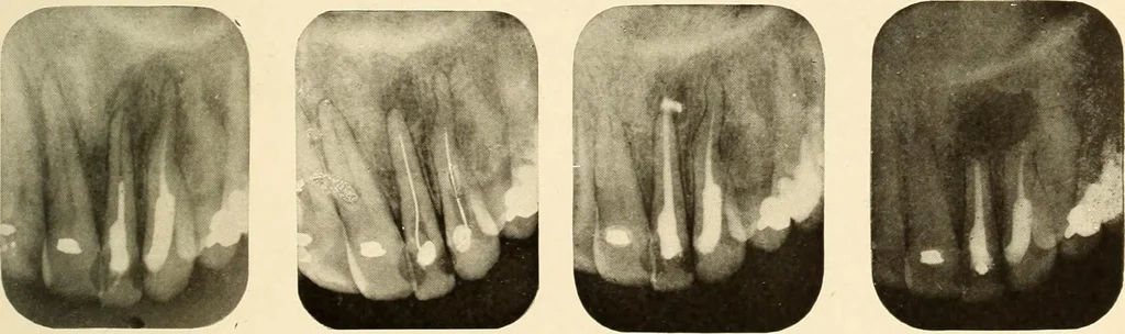 An illustration from Oral Roentgenology : a Roentgen study of the anatomy and pathology of the oral cavity, 1917, leaf 180