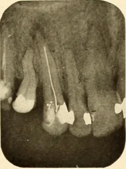 An illustration from Oral Roentgenology : a Roentgen study of the anatomy and pathology of the oral cavity, 1917, leaf 182