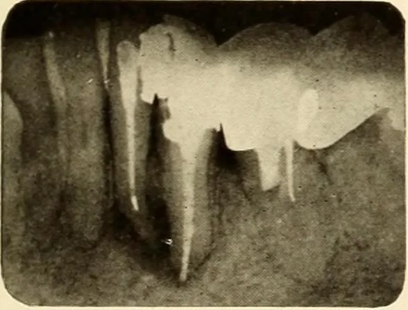 An illustration from Oral Roentgenology : a Roentgen study of the anatomy and pathology of the oral cavity, 1917, leaf 182