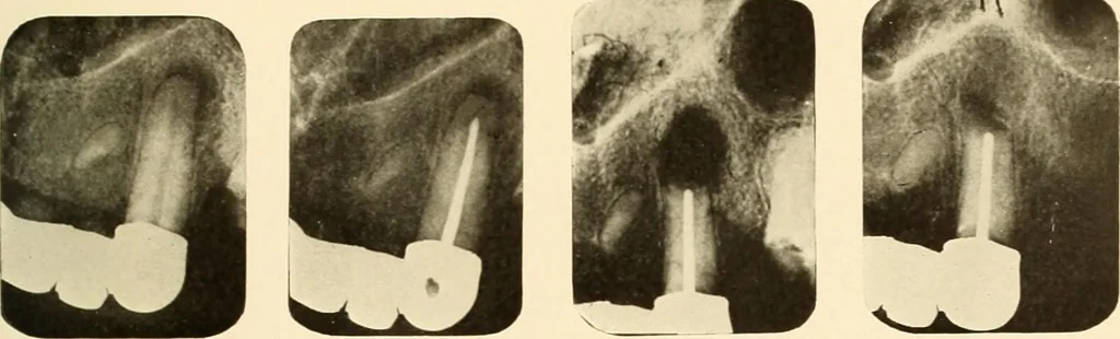 An illustration from Oral Roentgenology : a Roentgen study of the anatomy and pathology of the oral cavity, 1917, leaf 184