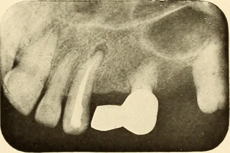 An illustration from Oral Roentgenology : a Roentgen study of the anatomy and pathology of the oral cavity, 1917, leaf 184