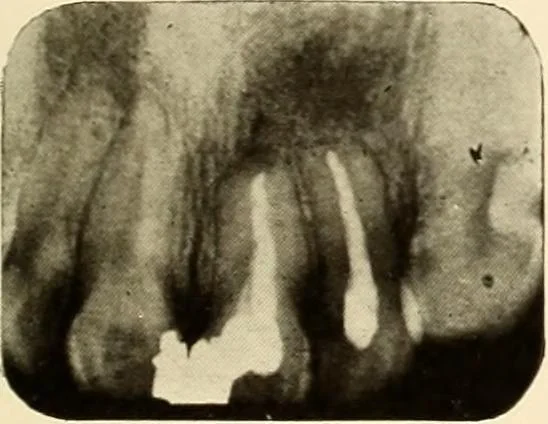 An illustration from Oral Roentgenology : a Roentgen study of the anatomy and pathology of the oral cavity, 1917, leaf 186