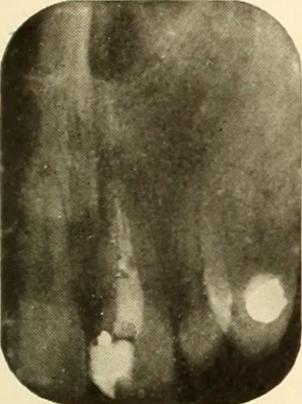 An illustration from Oral Roentgenology : a Roentgen study of the anatomy and pathology of the oral cavity, 1917, leaf 188
