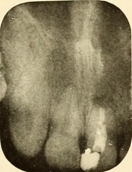 An illustration from Oral Roentgenology : a Roentgen study of the anatomy and pathology of the oral cavity, 1917, leaf 188