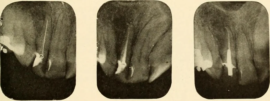 An illustration from Oral Roentgenology : a Roentgen study of the anatomy and pathology of the oral cavity, 1917, leaf 188