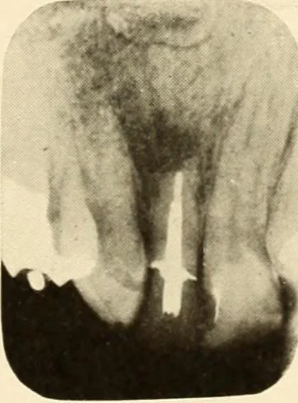 An illustration from Oral Roentgenology : a Roentgen study of the anatomy and pathology of the oral cavity, 1917, leaf 188