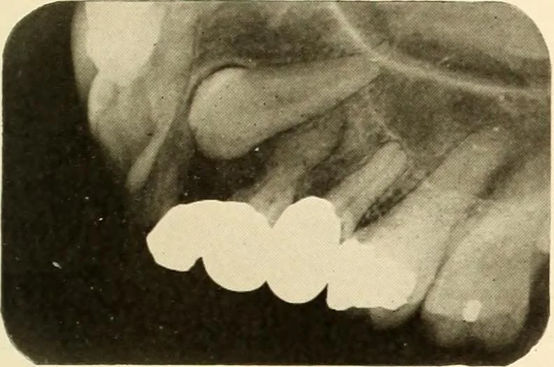 An illustration from Oral Roentgenology : a Roentgen study of the anatomy and pathology of the oral cavity, 1917, leaf 190