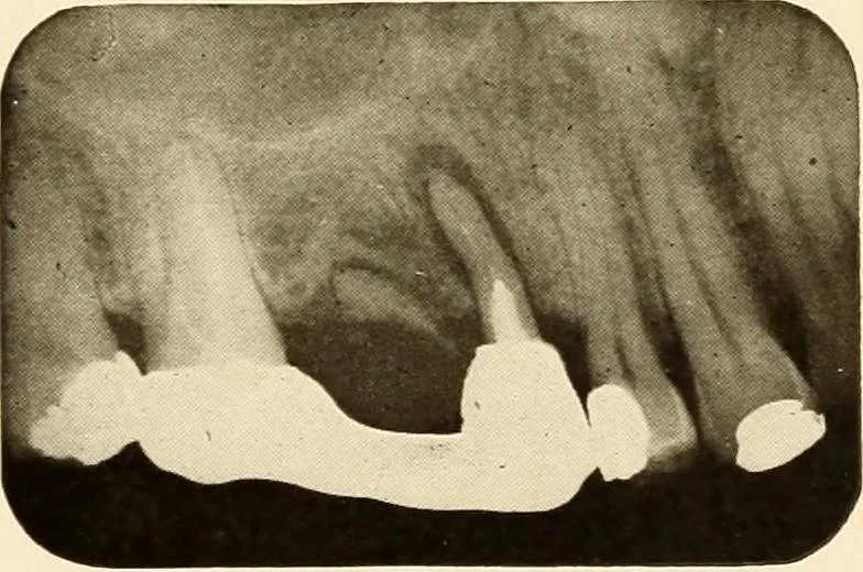 An illustration from Oral Roentgenology : a Roentgen study of the anatomy and pathology of the oral cavity, 1917, leaf 190