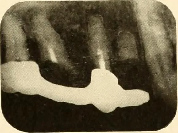 An illustration from Oral Roentgenology : a Roentgen study of the anatomy and pathology of the oral cavity, 1917, leaf 192