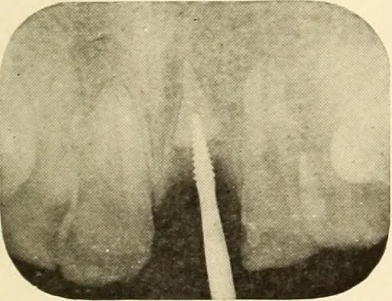 An illustration from Oral Roentgenology : a Roentgen study of the anatomy and pathology of the oral cavity, 1917, leaf 192