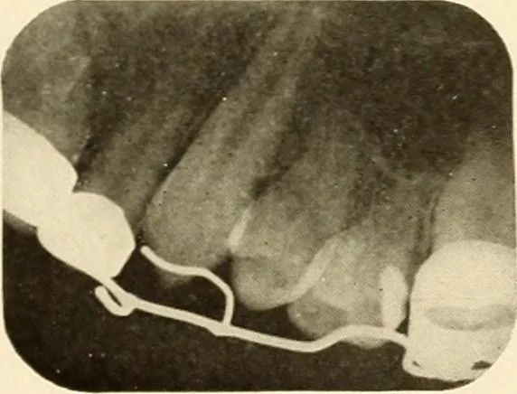 An illustration from Oral Roentgenology : a Roentgen study of the anatomy and pathology of the oral cavity, 1917, leaf 194