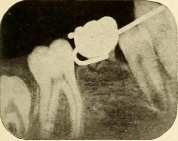 An illustration from Oral Roentgenology : a Roentgen study of the anatomy and pathology of the oral cavity, 1917, leaf 194