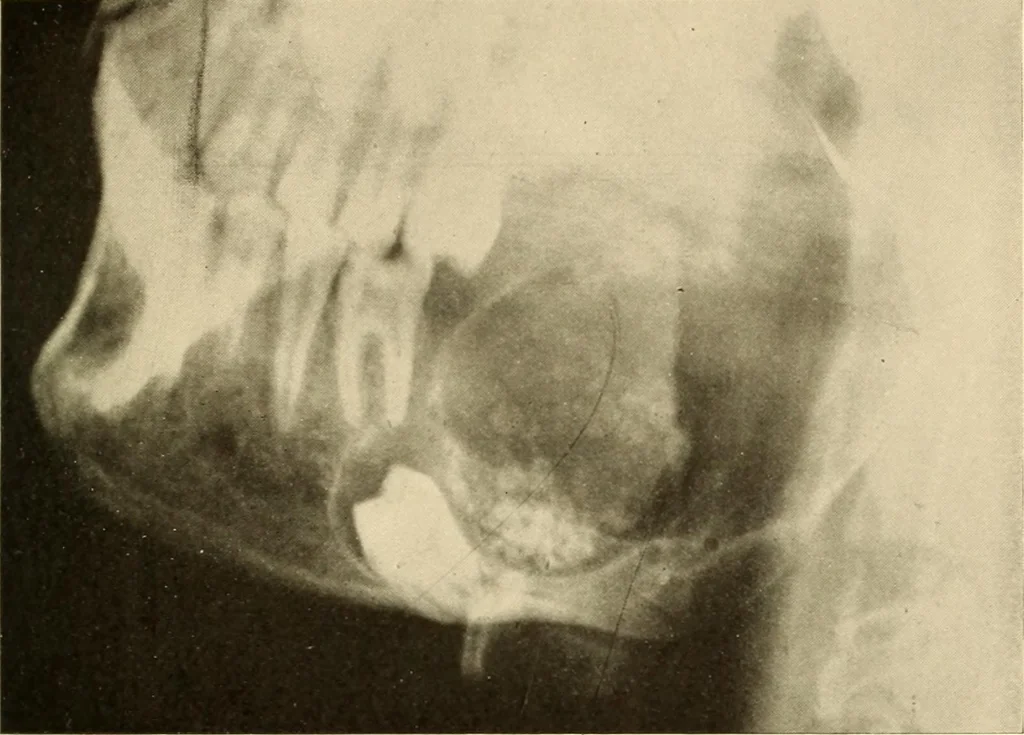 An illustration from Oral Roentgenology : a Roentgen study of the anatomy and pathology of the oral cavity, 1917, leaf 196