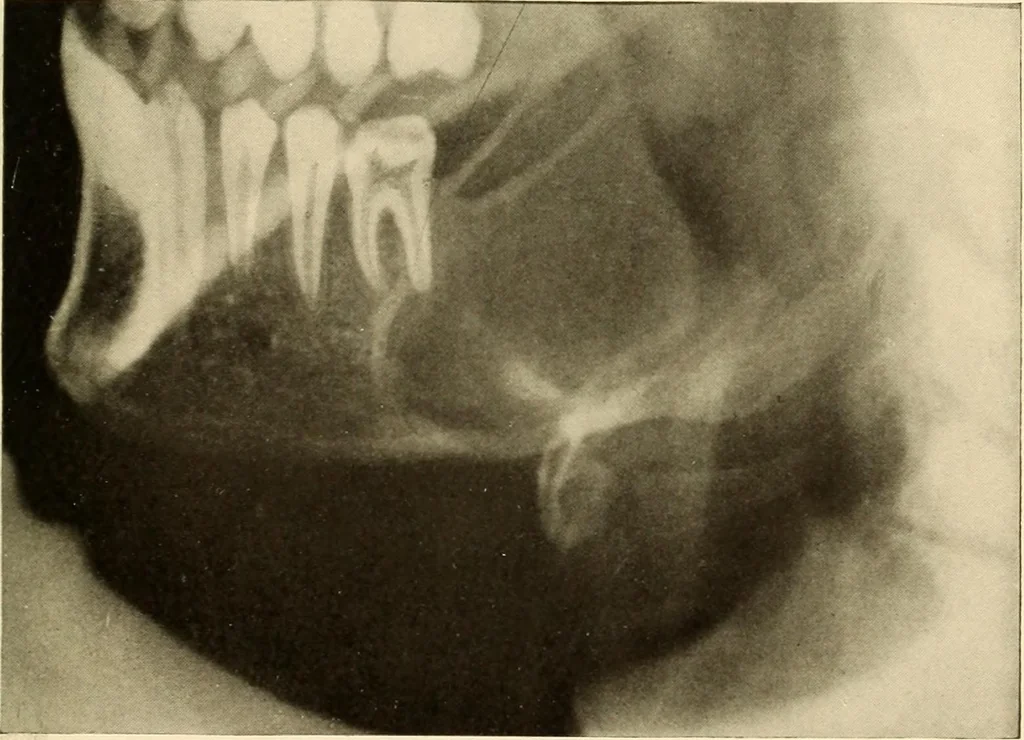 An illustration from Oral Roentgenology : a Roentgen study of the anatomy and pathology of the oral cavity, 1917, leaf 196