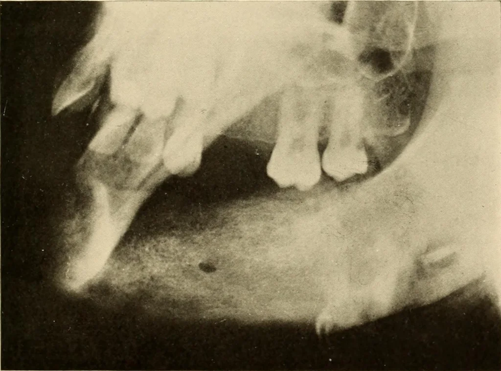An illustration from Oral Roentgenology : a Roentgen study of the anatomy and pathology of the oral cavity, 1917, leaf 198