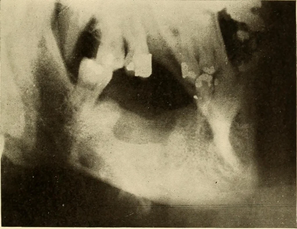 An illustration from Oral Roentgenology : a Roentgen study of the anatomy and pathology of the oral cavity, 1917, leaf 202