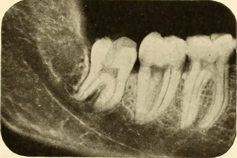 An illustration from Oral Roentgenology : a Roentgen study of the anatomy and pathology of the oral cavity, 1917, leaf 22