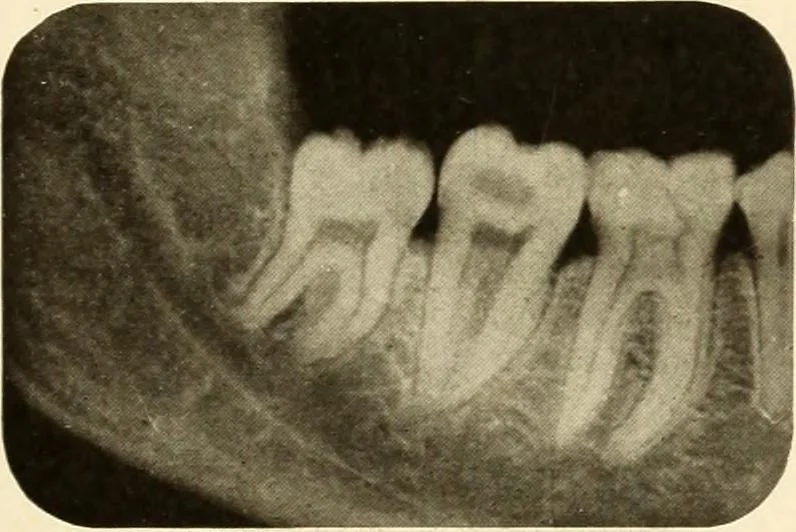An illustration from Oral Roentgenology : a Roentgen study of the anatomy and pathology of the oral cavity, 1917, leaf 22