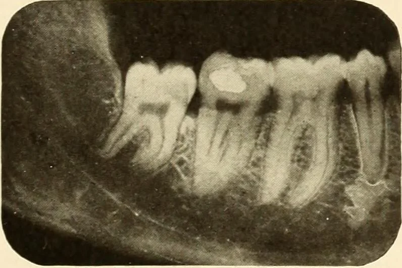 An illustration from Oral Roentgenology : a Roentgen study of the anatomy and pathology of the oral cavity, 1917, leaf 22