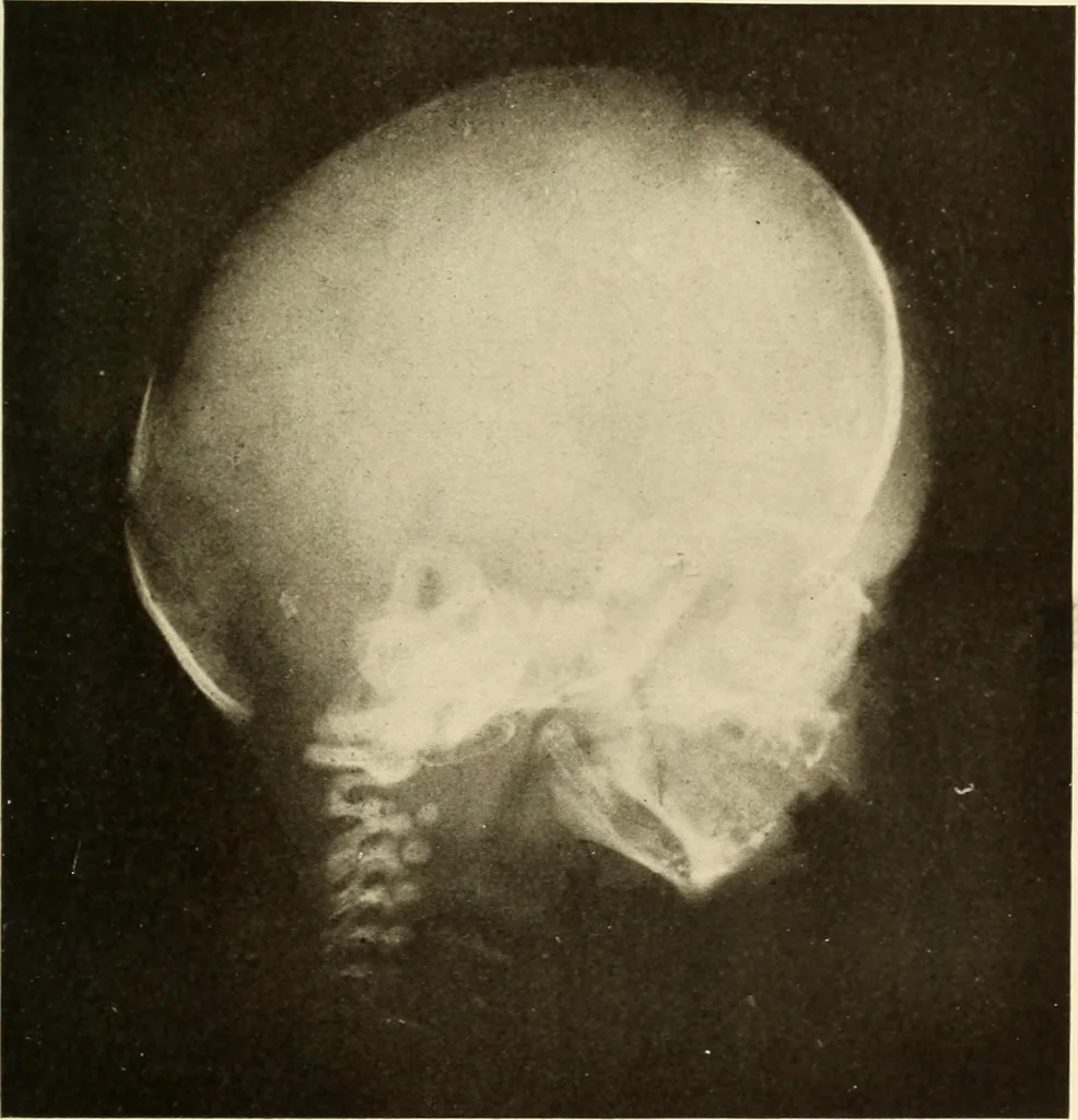 An illustration from Oral Roentgenology : a Roentgen study of the anatomy and pathology of the oral cavity, 1917, leaf 34