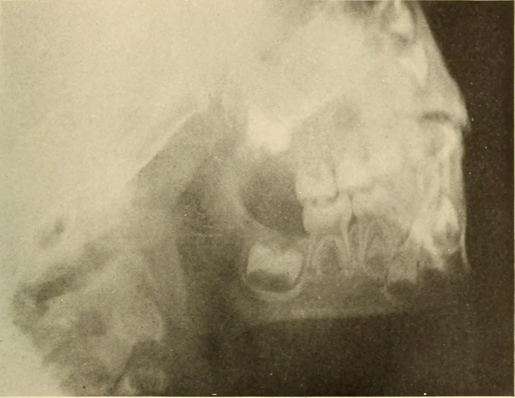 An illustration from Oral Roentgenology : a Roentgen study of the anatomy and pathology of the oral cavity, 1917, leaf 36
