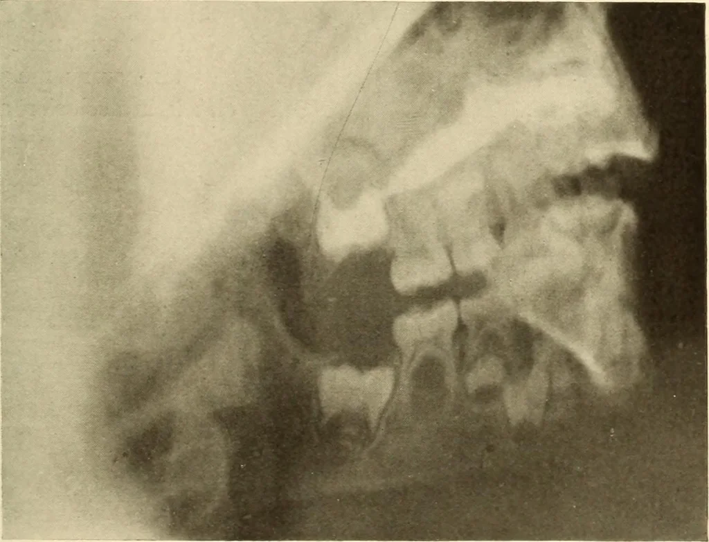 An illustration from Oral Roentgenology : a Roentgen study of the anatomy and pathology of the oral cavity, 1917, leaf 36