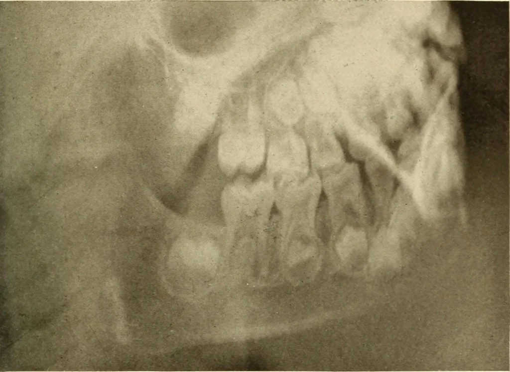 An illustration from Oral Roentgenology : a Roentgen study of the anatomy and pathology of the oral cavity, 1917, leaf 38