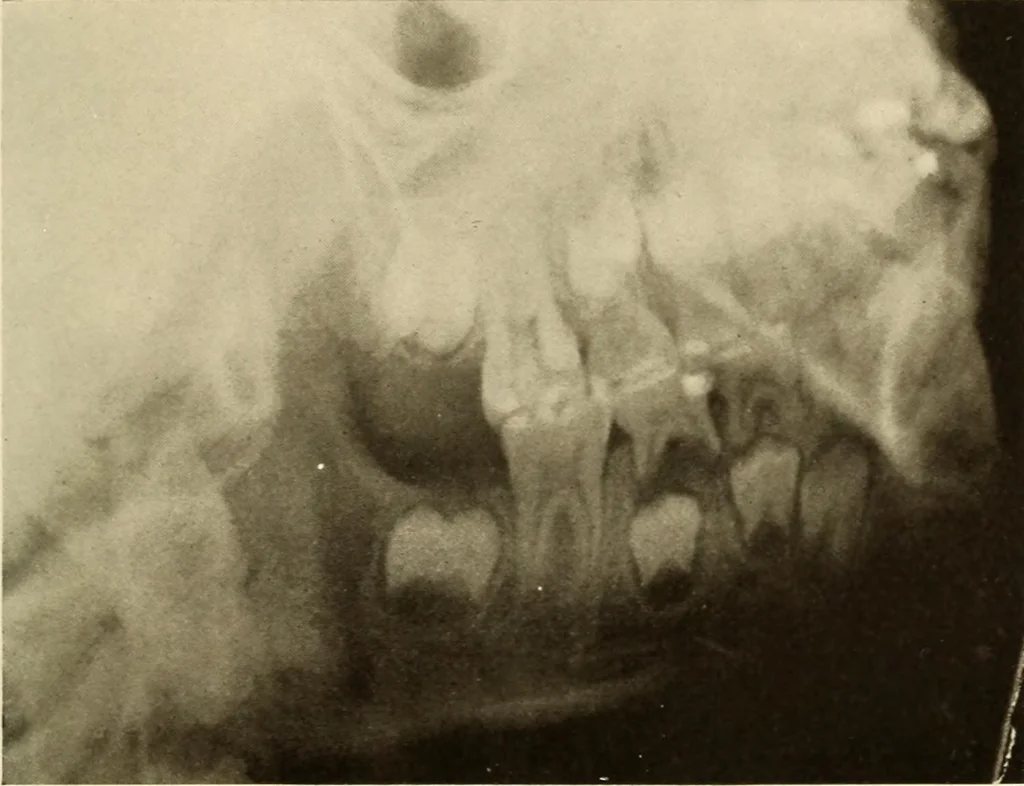 An illustration from Oral Roentgenology : a Roentgen study of the anatomy and pathology of the oral cavity, 1917, leaf 38