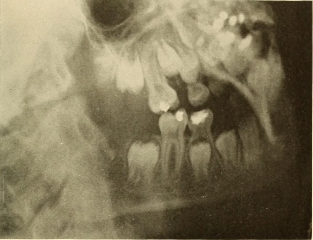 An illustration from Oral Roentgenology : a Roentgen study of the anatomy and pathology of the oral cavity, 1917, leaf 40