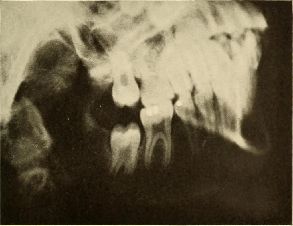 An illustration from Oral Roentgenology : a Roentgen study of the anatomy and pathology of the oral cavity, 1917, leaf 40