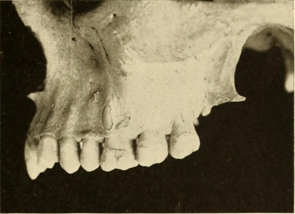 An illustration from Oral Roentgenology : a Roentgen study of the anatomy and pathology of the oral cavity, 1917, leaf 42