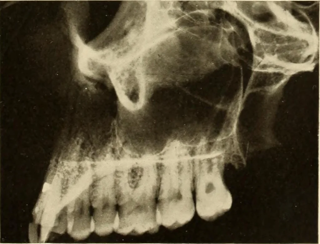 An illustration from Oral Roentgenology : a Roentgen study of the anatomy and pathology of the oral cavity, 1917, leaf 42