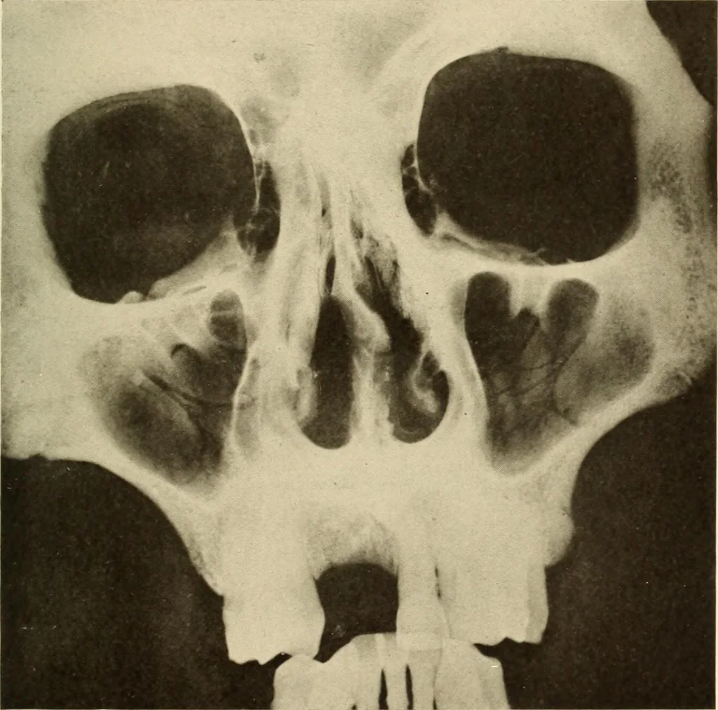 An illustration from Oral Roentgenology : a Roentgen study of the anatomy and pathology of the oral cavity, 1917, leaf 44