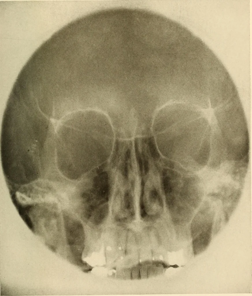 An illustration from Oral Roentgenology : a Roentgen study of the anatomy and pathology of the oral cavity, 1917, leaf 46