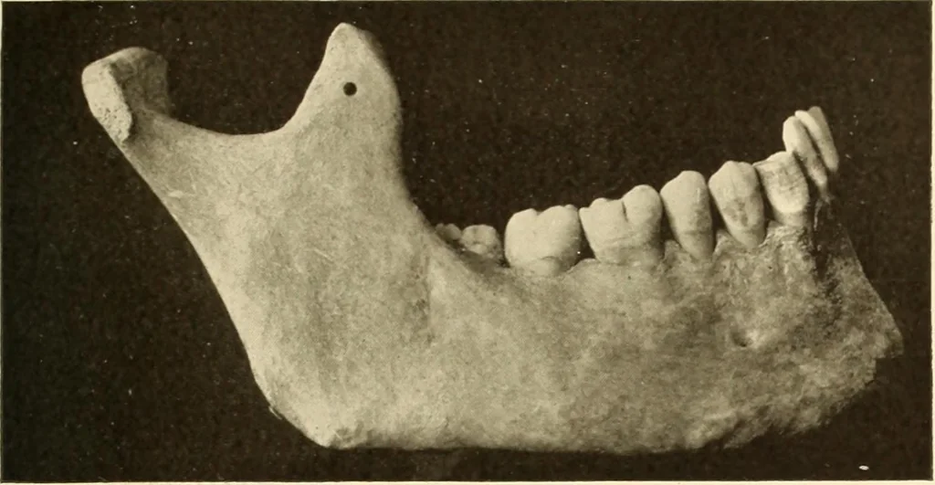 An illustration from Oral Roentgenology : a Roentgen study of the anatomy and pathology of the oral cavity, 1917, leaf 48