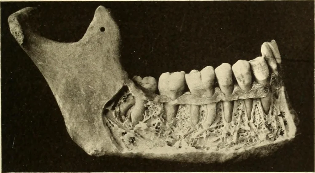 An illustration from Oral Roentgenology : a Roentgen study of the anatomy and pathology of the oral cavity, 1917, leaf 48