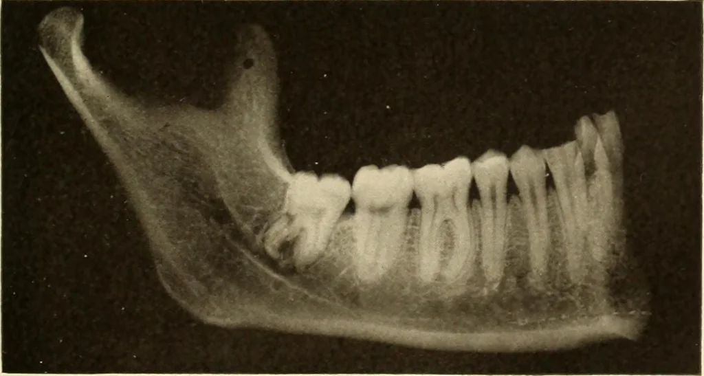 An illustration from Oral Roentgenology : a Roentgen study of the anatomy and pathology of the oral cavity, 1917, leaf 48