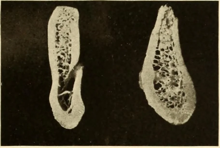 An illustration from Oral Roentgenology : a Roentgen study of the anatomy and pathology of the oral cavity, 1917, leaf 50