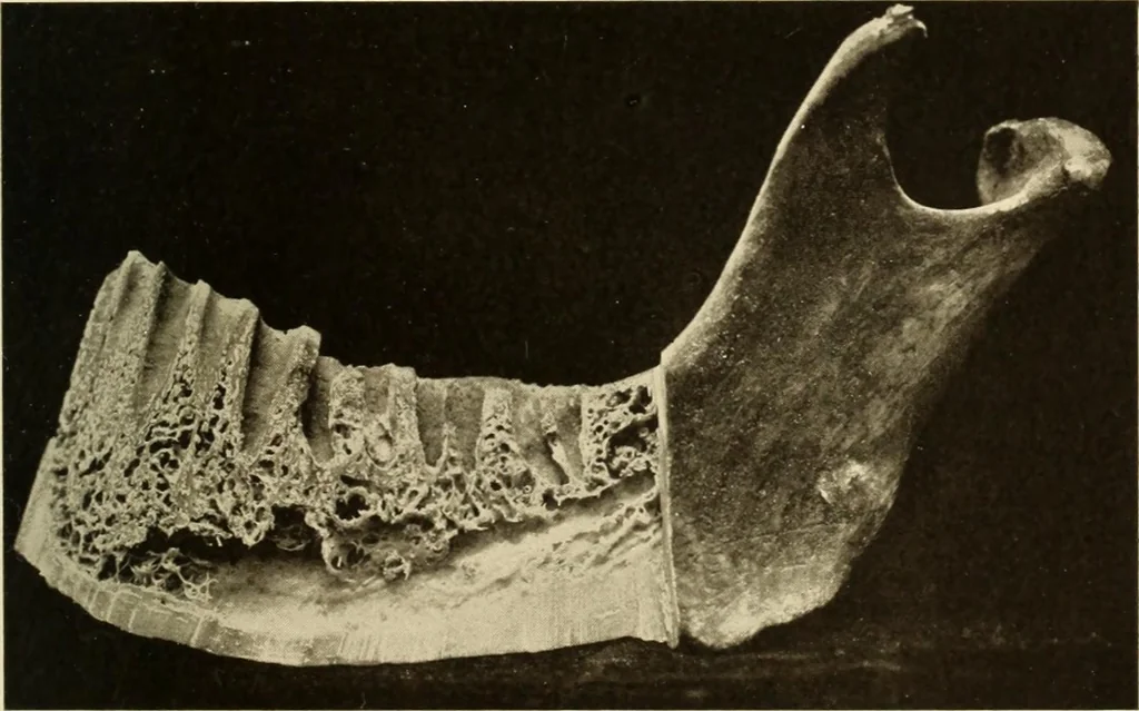 An illustration from Oral Roentgenology : a Roentgen study of the anatomy and pathology of the oral cavity, 1917, leaf 50
