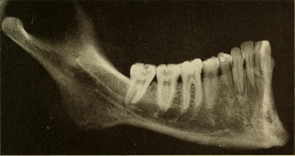 An illustration from Oral Roentgenology : a Roentgen study of the anatomy and pathology of the oral cavity, 1917, leaf 52