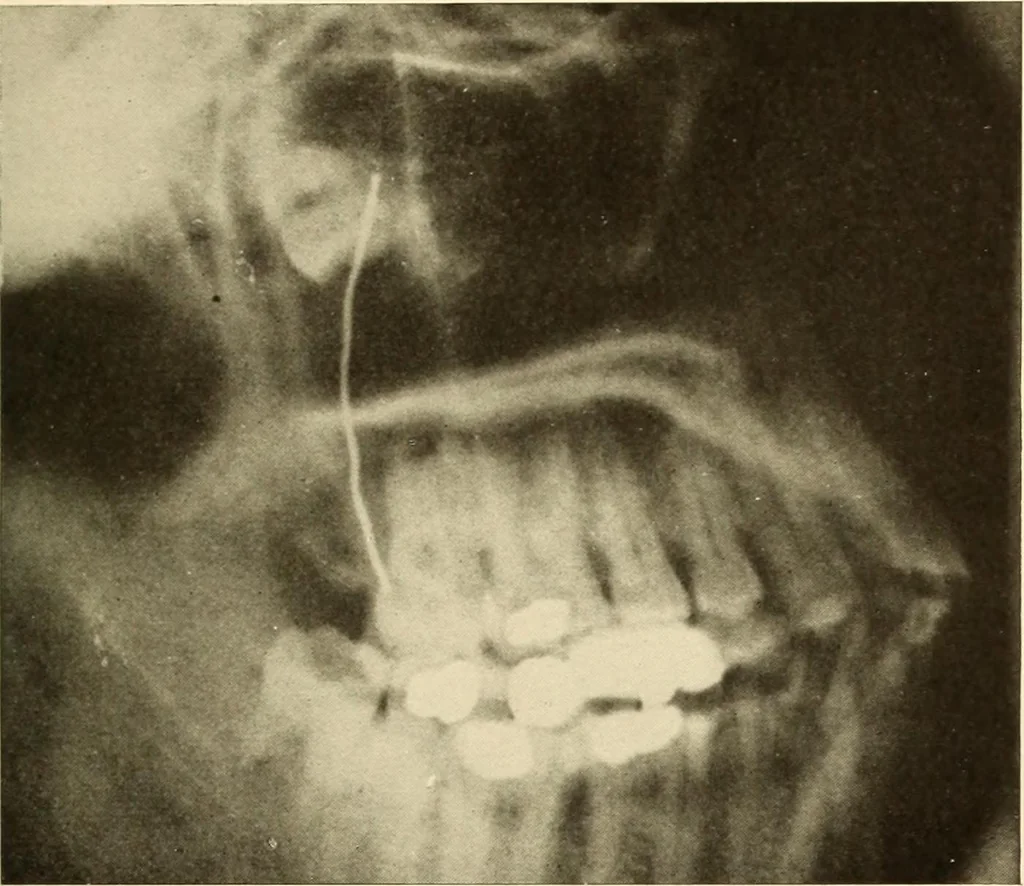An illustration from Oral Roentgenology : a Roentgen study of the anatomy and pathology of the oral cavity, 1917, leaf 60