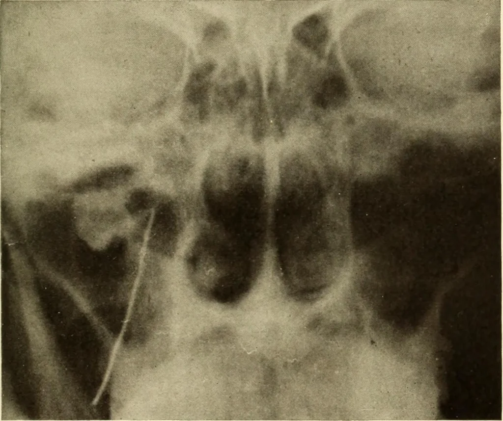 An illustration from Oral Roentgenology : a Roentgen study of the anatomy and pathology of the oral cavity, 1917, leaf 60