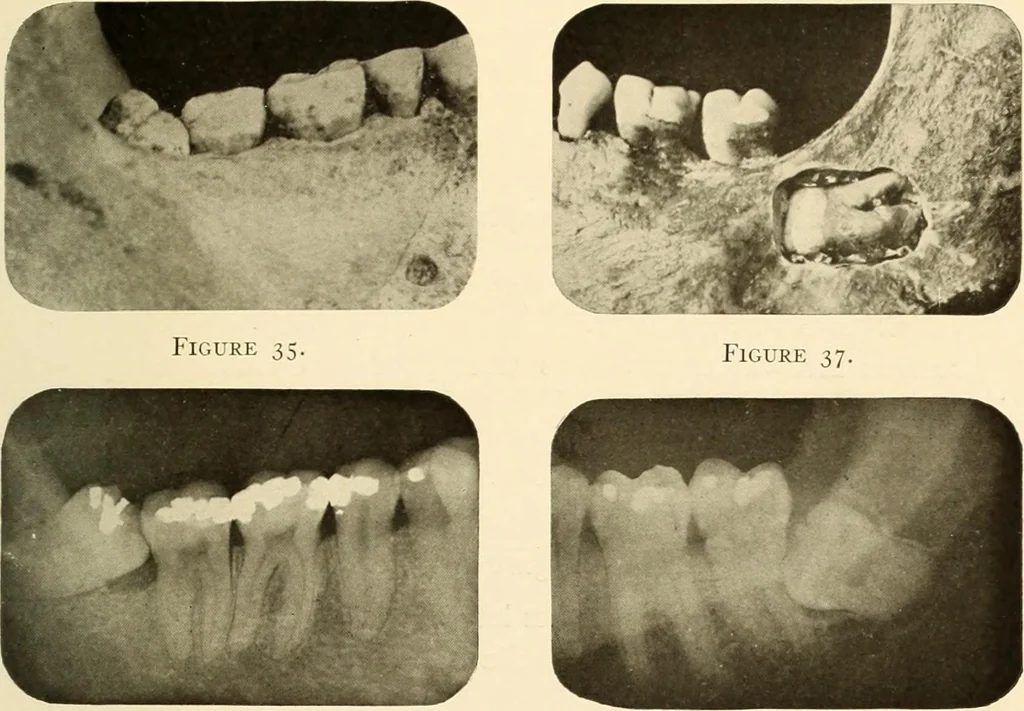 An illustration from Oral Roentgenology : a Roentgen study of the anatomy and pathology of the oral cavity, 1917, leaf 62