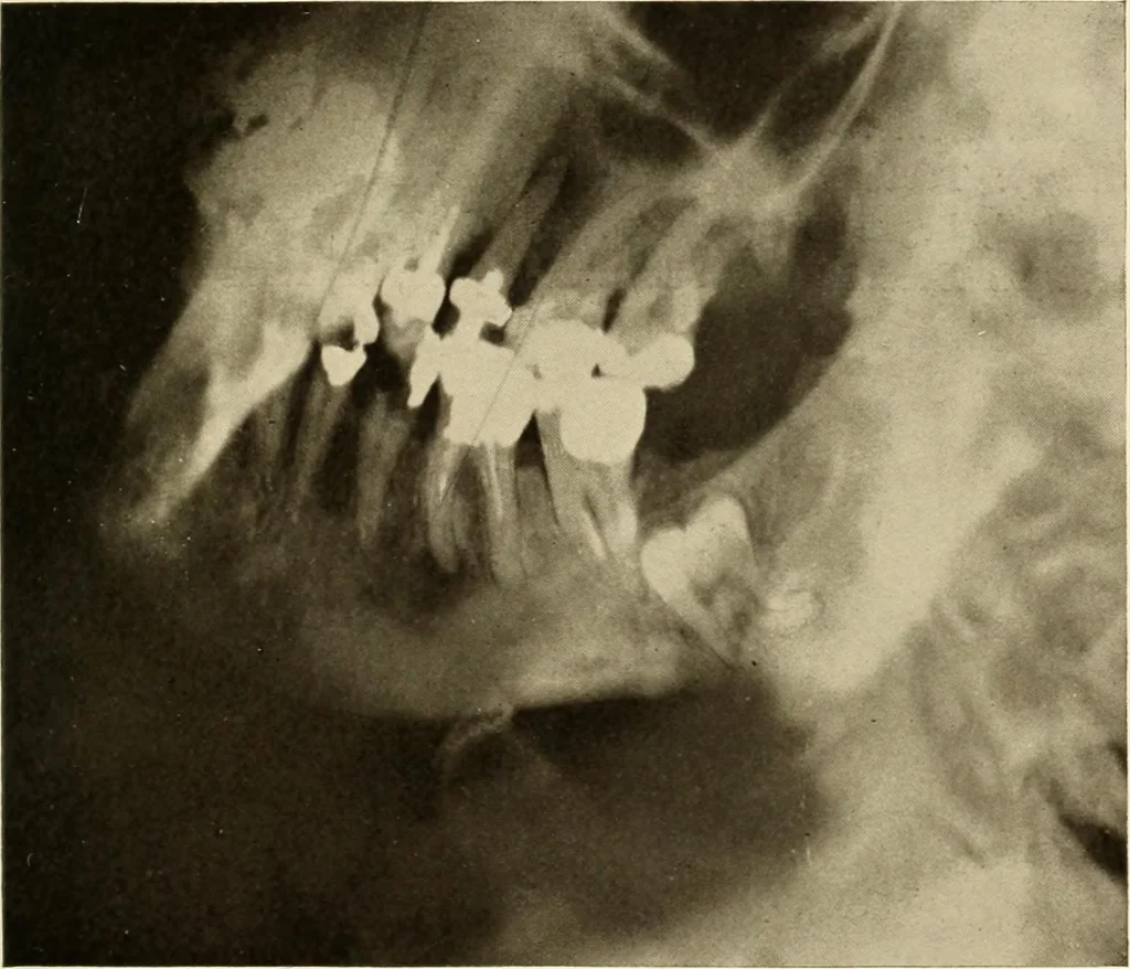 An illustration from Oral Roentgenology : a Roentgen study of the anatomy and pathology of the oral cavity, 1917, leaf 62