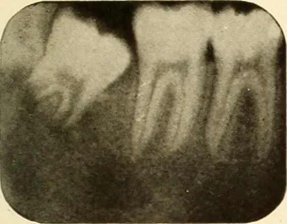 An illustration from Oral Roentgenology : a Roentgen study of the anatomy and pathology of the oral cavity, 1917, leaf 64