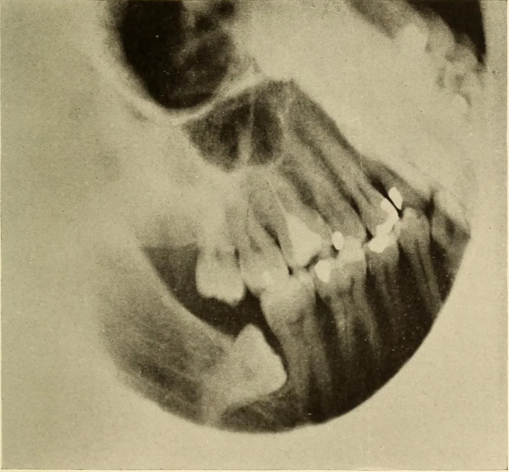 An illustration from Oral Roentgenology : a Roentgen study of the anatomy and pathology of the oral cavity, 1917, leaf 64