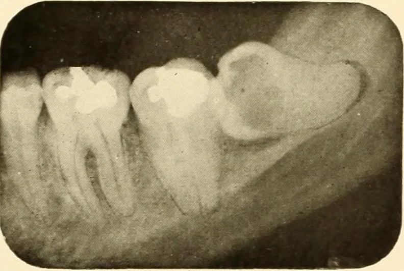 An illustration from Oral Roentgenology : a Roentgen study of the anatomy and pathology of the oral cavity, 1917, leaf 66